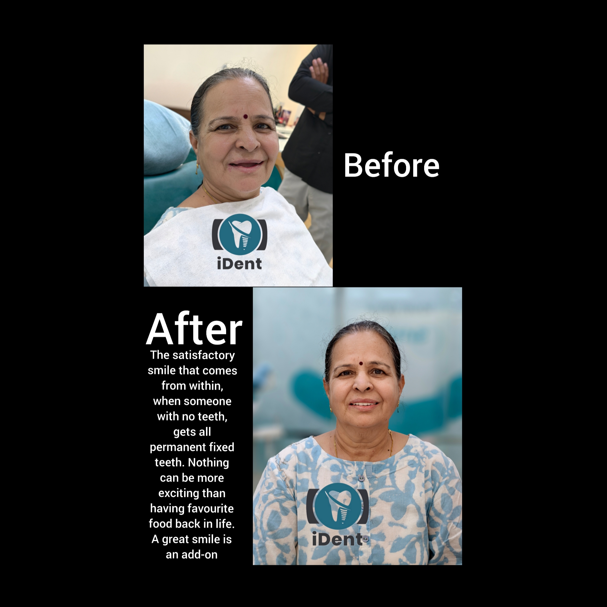 Before and after dental implant treatment