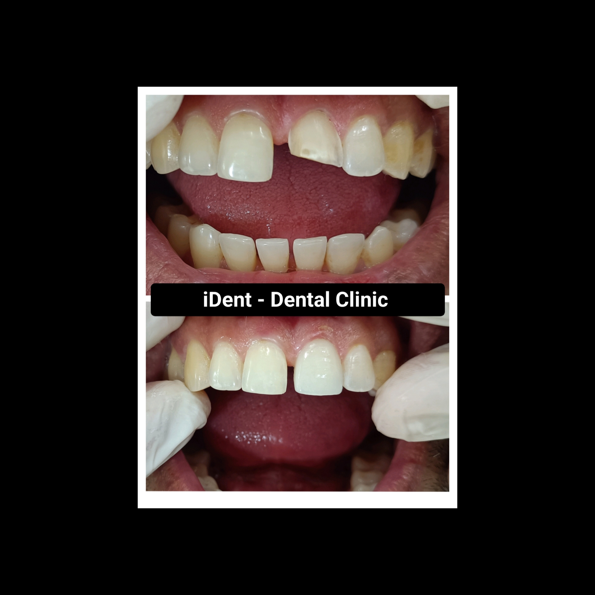 Before and after root canal treatment